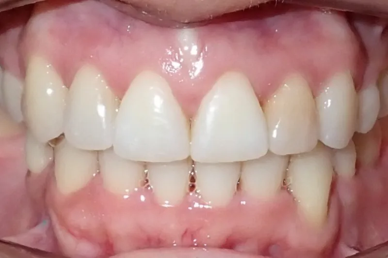 Crowding after orthodontic treatment