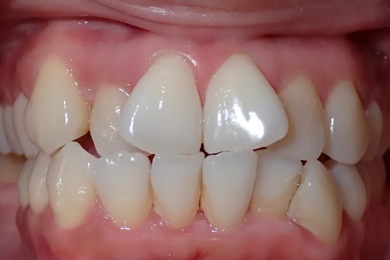 Crowding before orthodontic treatment