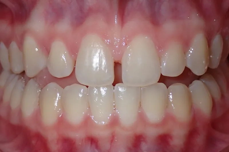 Open Bite before orthodontic treatment