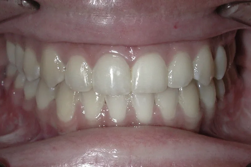 Orthognathic Surgery after orthodontic treatment