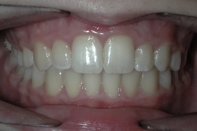 Spaces after orthodontic treatment