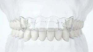 How Do Invisalign Clear Aligners Actually Work?